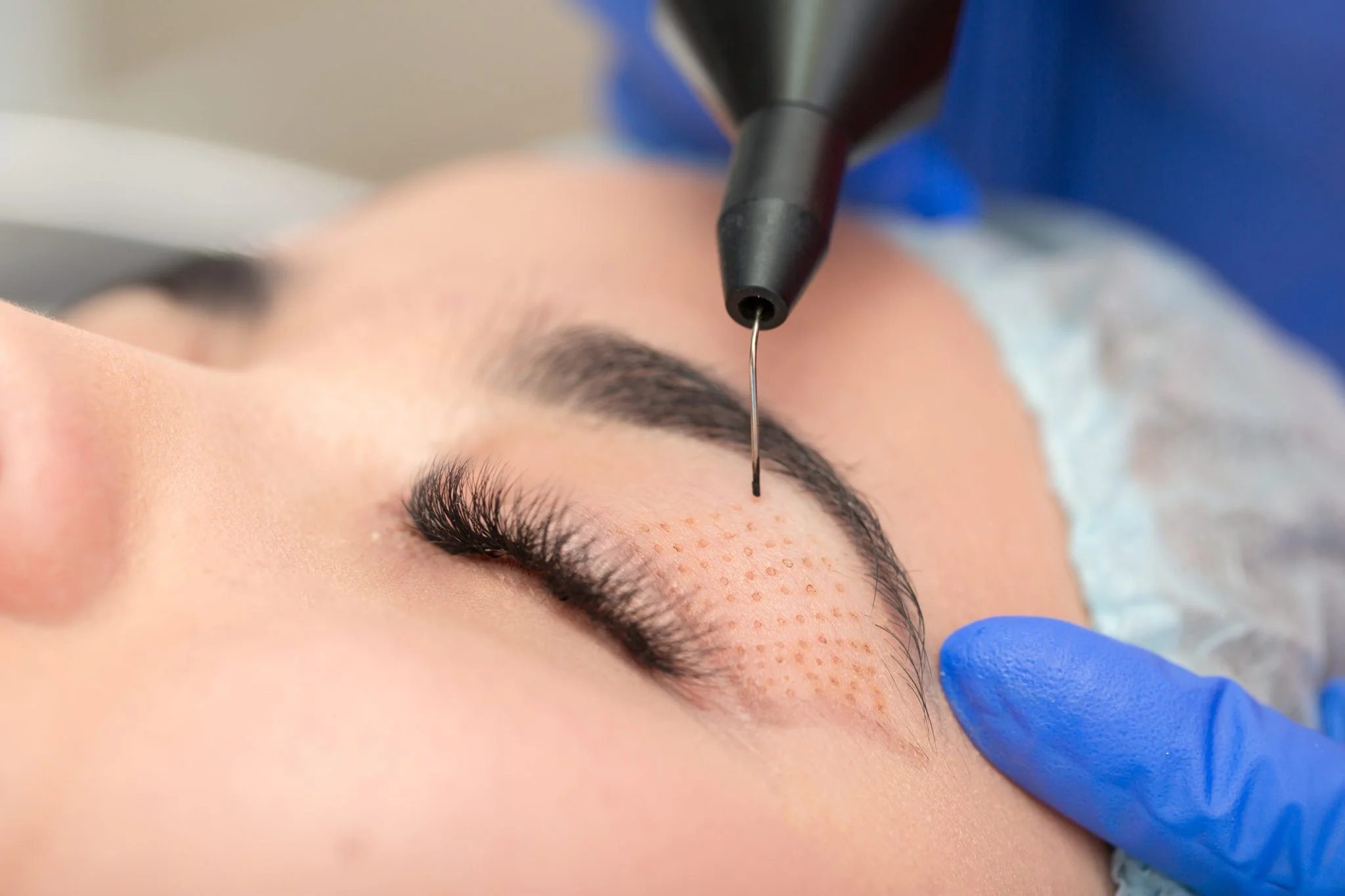 plasma iq treatment st albans