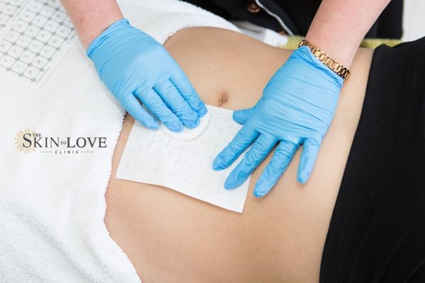 Thermage Skin Tightening: Thermage FLX Skin Treatment: Collagen Production throughout all layers of the skin to tighten and contour.