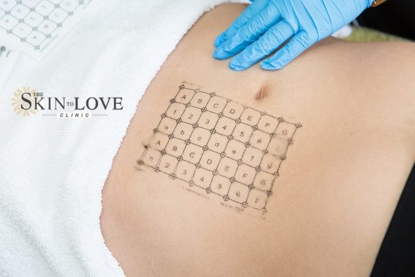 Thermage Skin Tightening: Thermage FLX Skin Treatment. Thermage helps all layers of the skin. Thermale FLX for Sagging Skin.