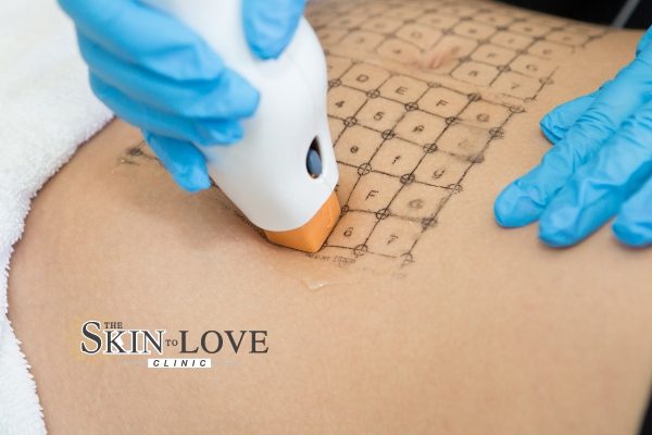 Thermage FLX Radiofrequency Technology: Depending on your skin and skin types, thermage works to give you smoother skin by introducing new collagen.