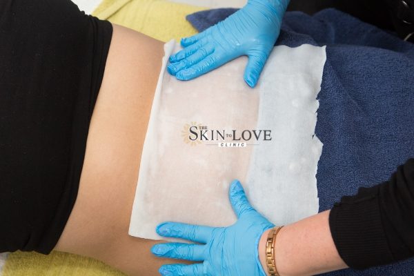 fat freezing near me