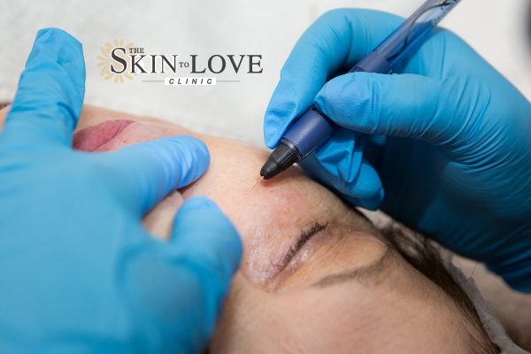 Veinwave treatment st albans