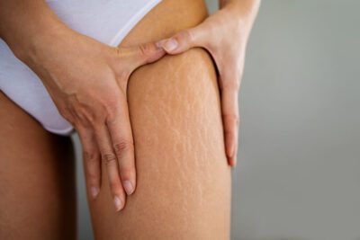 stretch mark removal