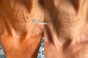Profhilo Treatment