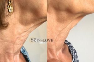 Profhilo Treatment