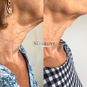 Profhilo before and after photos