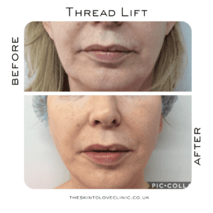 Thread Lift Results, Before & After Photos