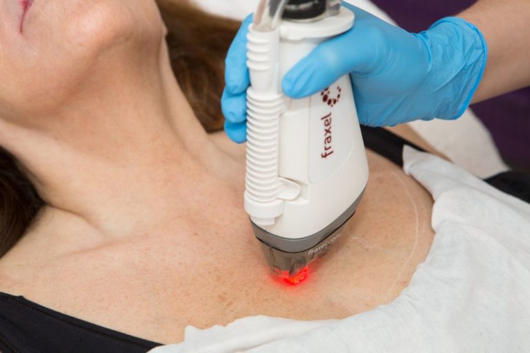 Fraxel Laser