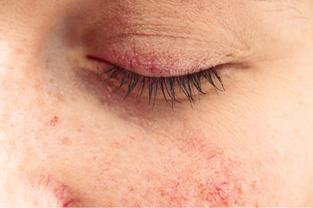 Rosacea Treatment 