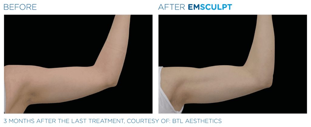 Emsculpt Neo Before and After