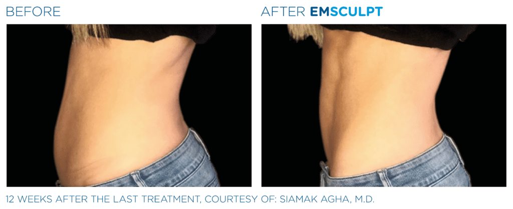 Emsculpt Neo Before and After