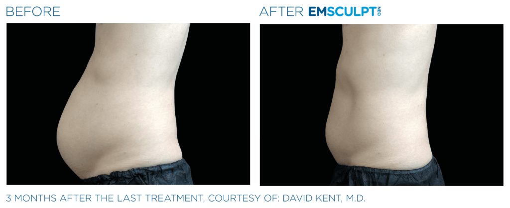 Emsculpt Neo Before and After