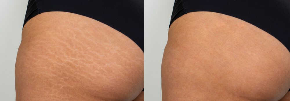 deso fat-dissolving before and after