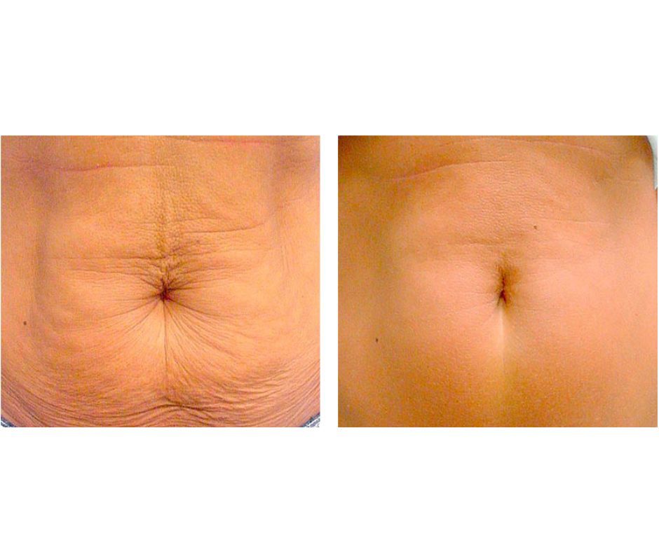 deso fat-dissolving before and after