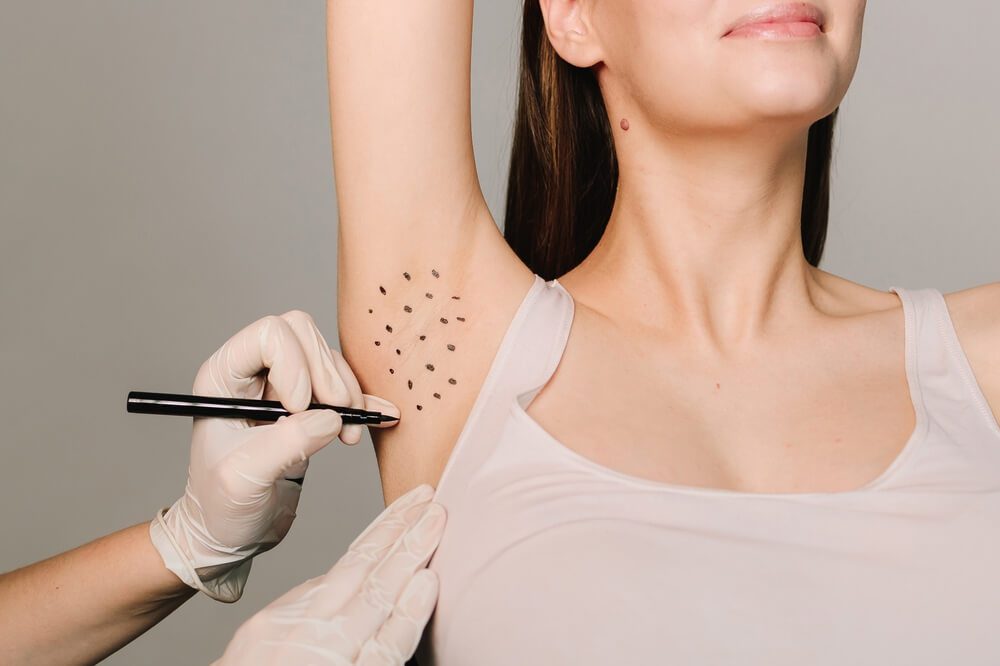 Hyperhidrosis Treatment st albans