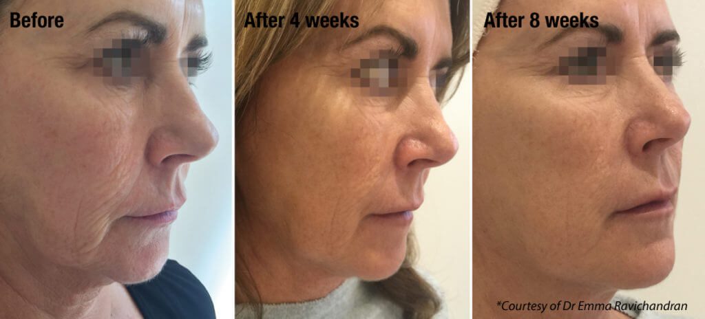 Before and After Profhilo