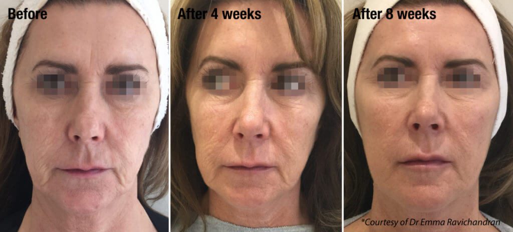 Profhilo and Bioremodelling