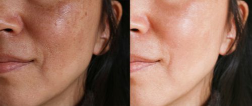 Can Melasma Be Treated?