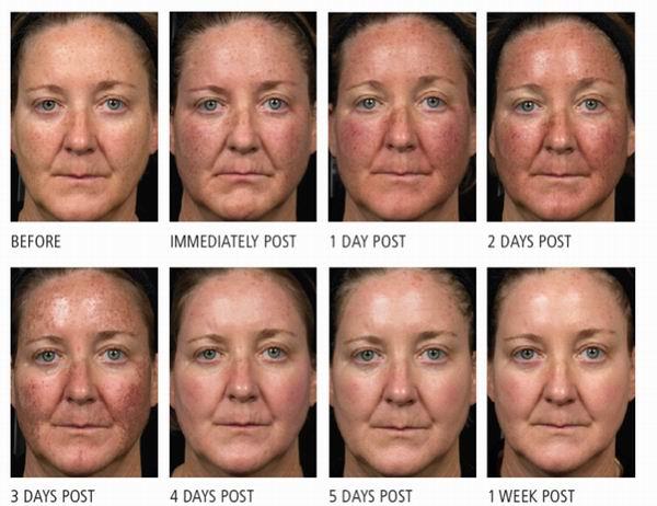 fraxel before and after