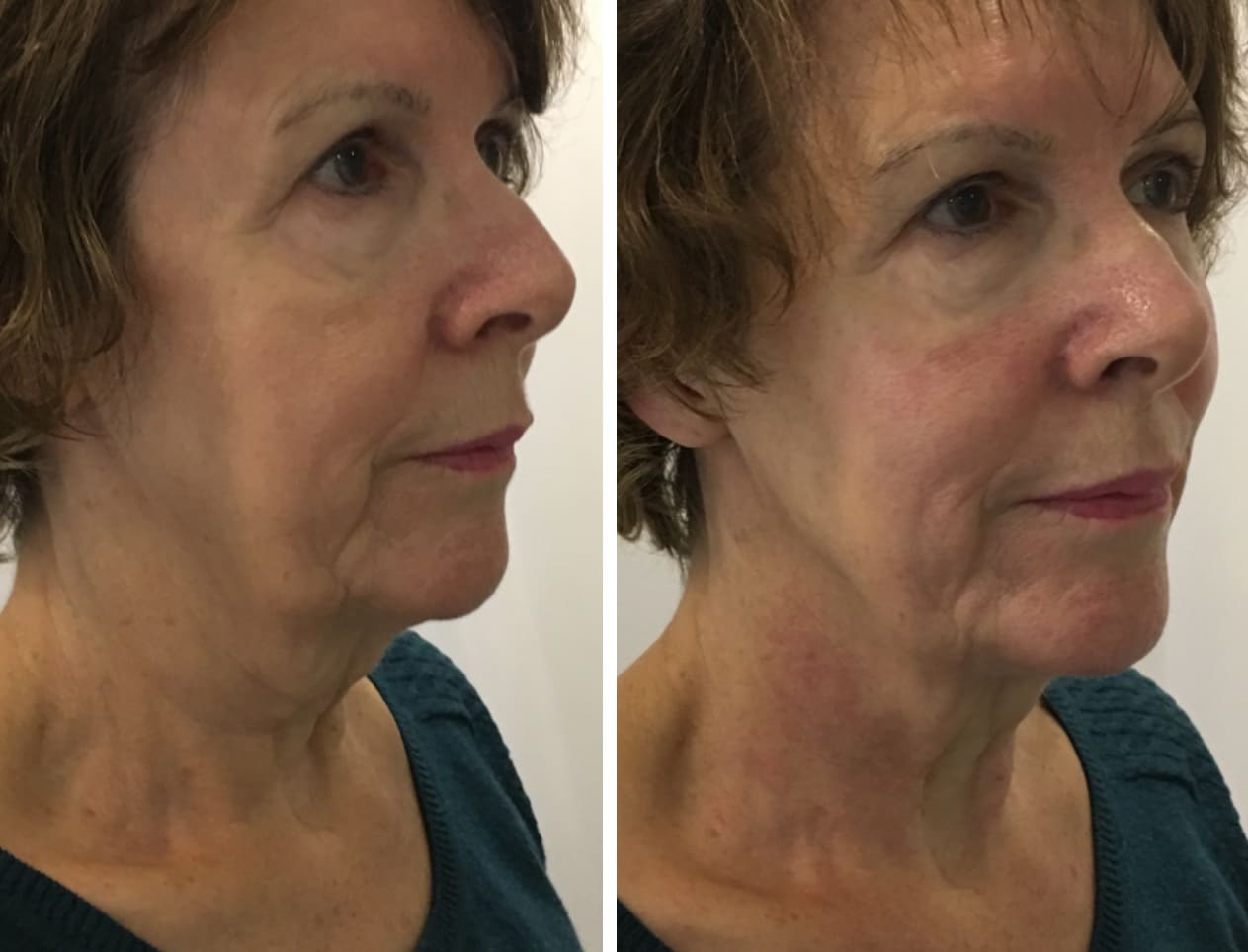 HIFU Treatment before and after Skin to Love Clinic