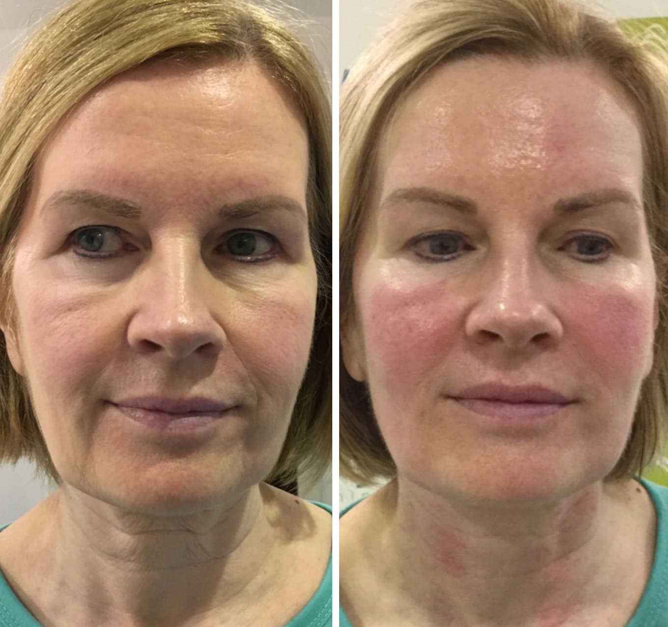 HIFU Treatment before and after Skin to Love Clinic