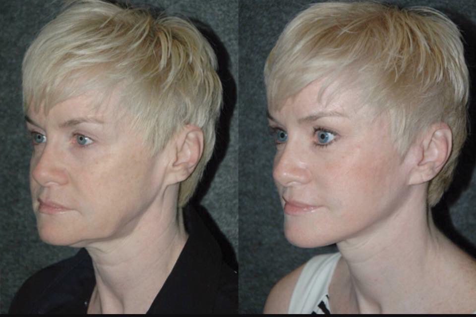 HIFU Treatment before and after Skin to Love Clinic