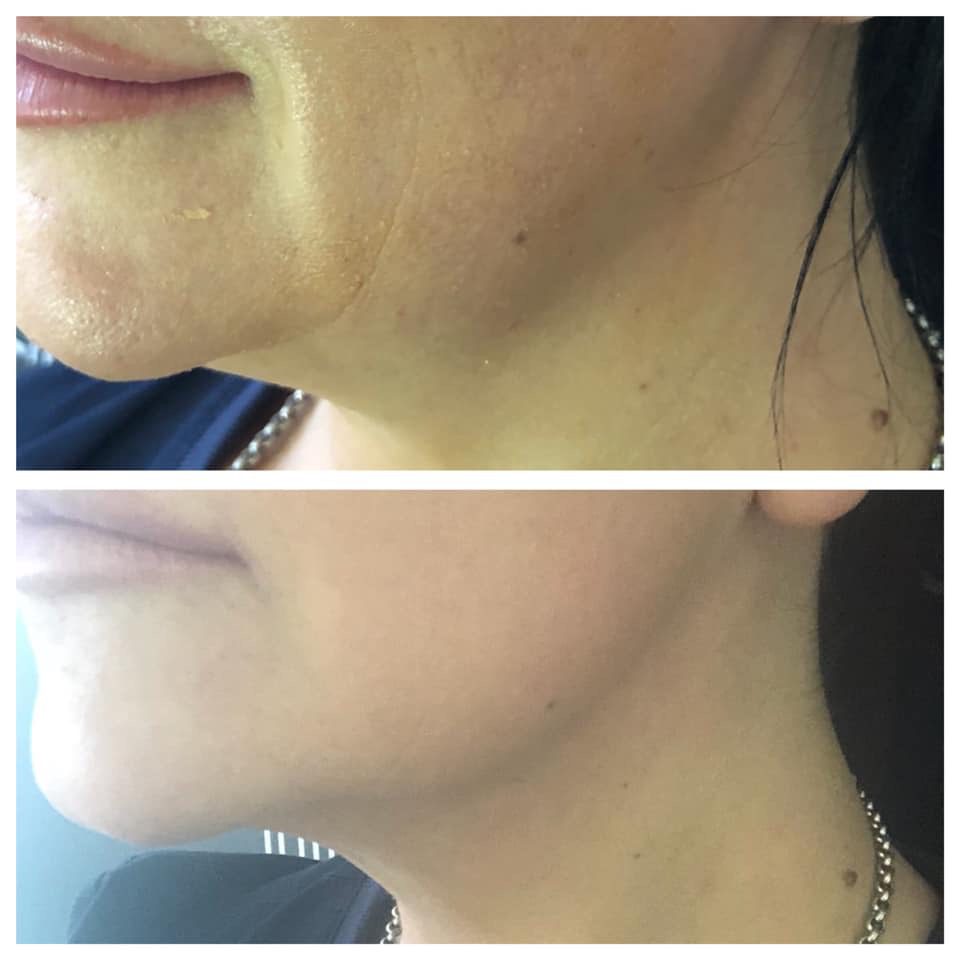 HIFU Treatment before and after Skin to Love Clinic