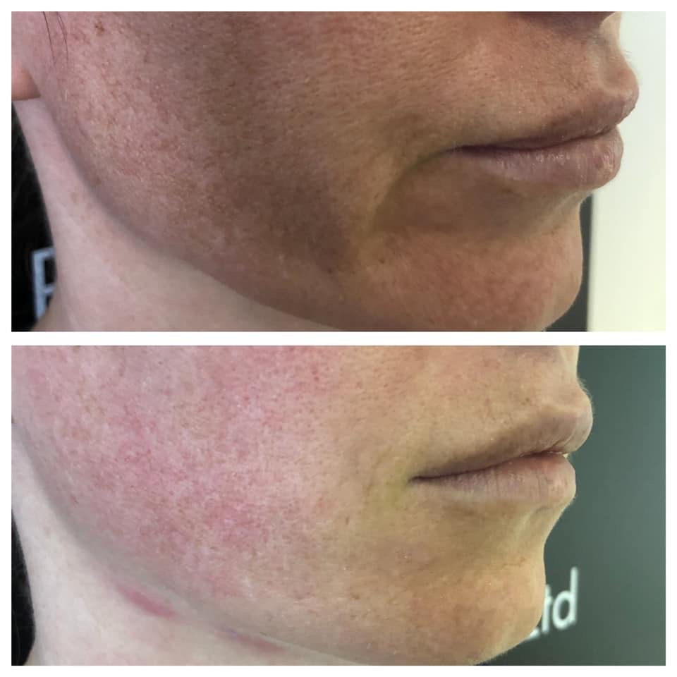 HIFU Treatment before and after Skin to Love Clinic