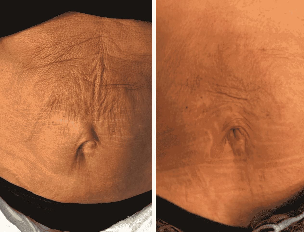 HIFU Treatment before and after Skin to Love Clinic
