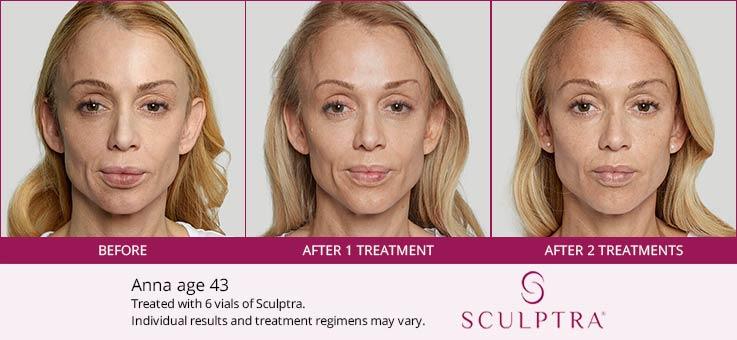 sculptra injection 