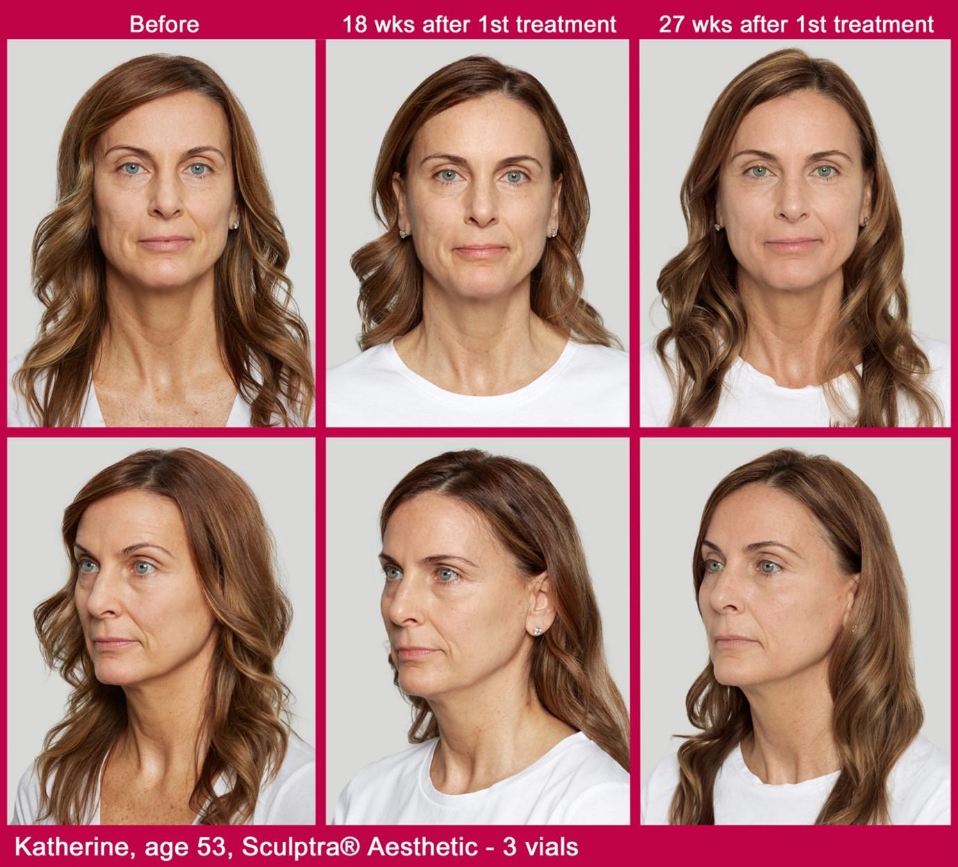 sculptra injections