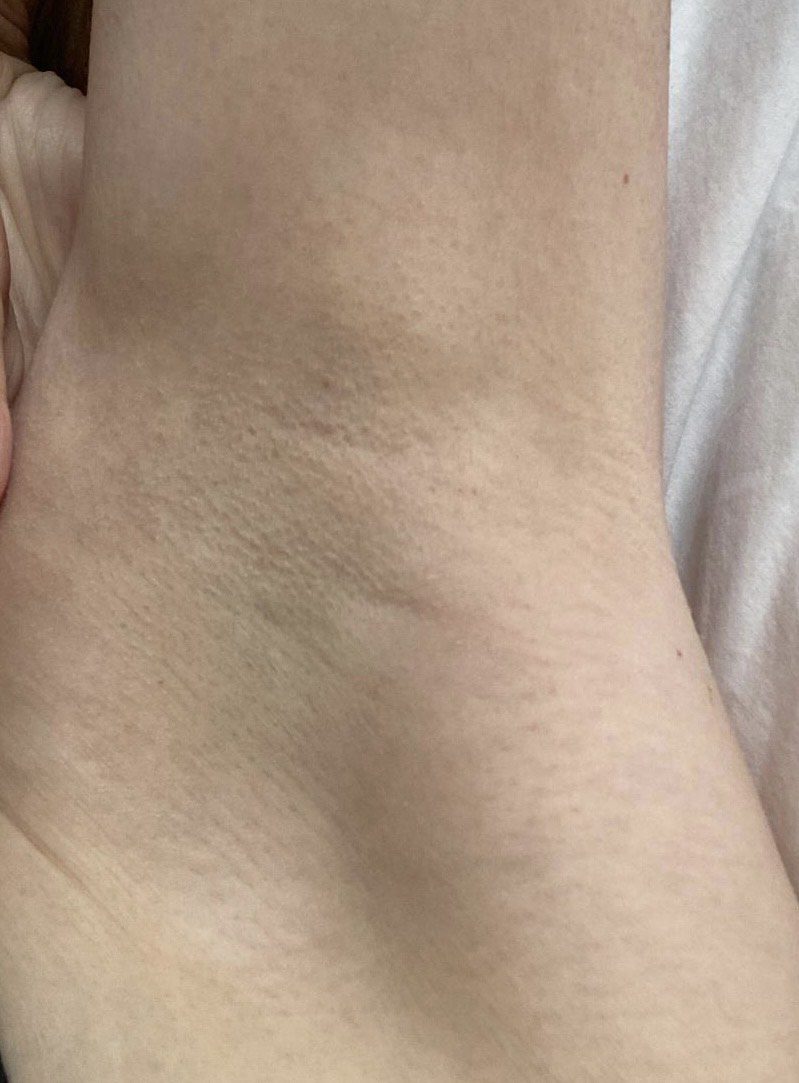 Underarm Laser Hair Removal before and after