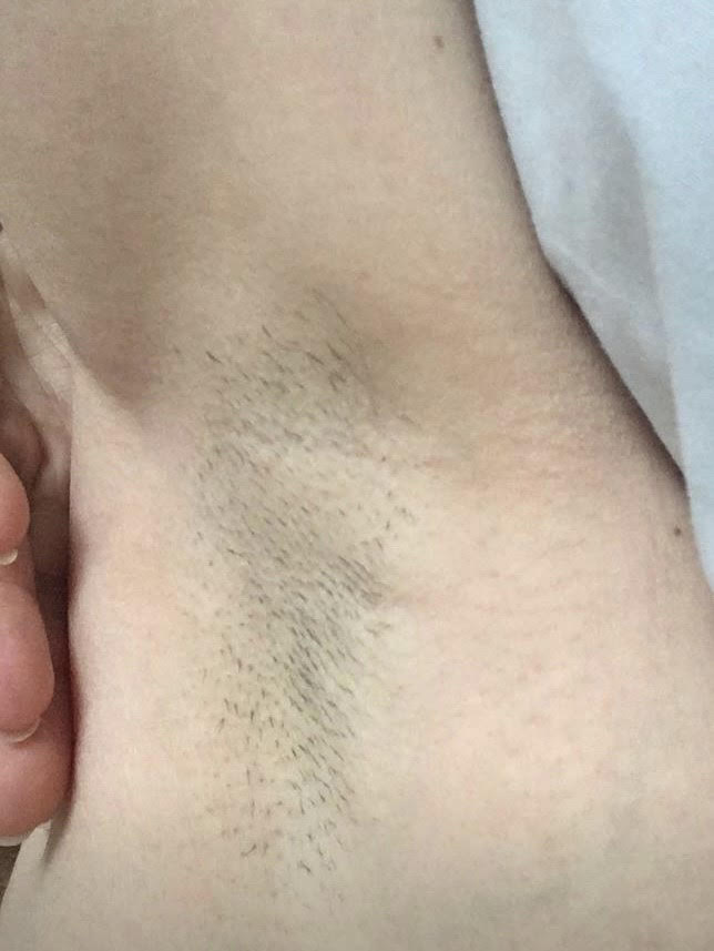 Underarm Laser Hair Removal before and after
