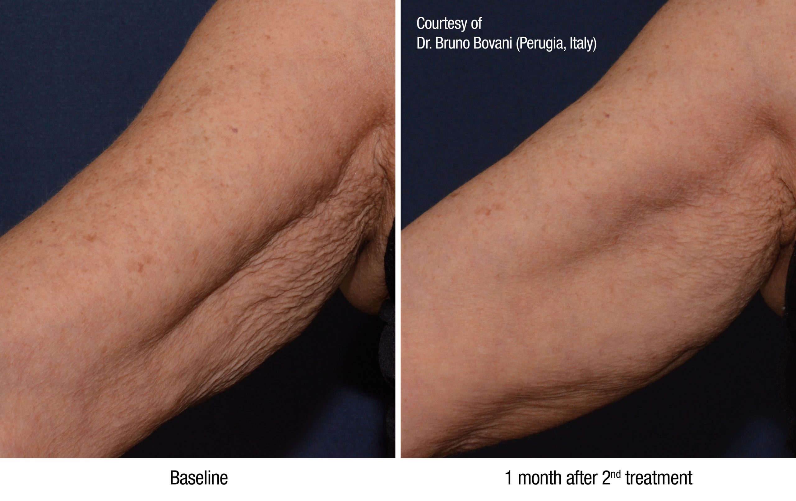 Profhilo before and after
