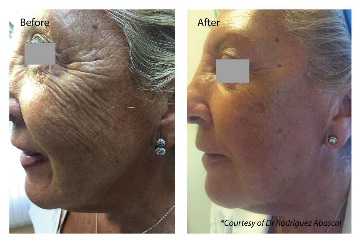 Profhilo before and after results