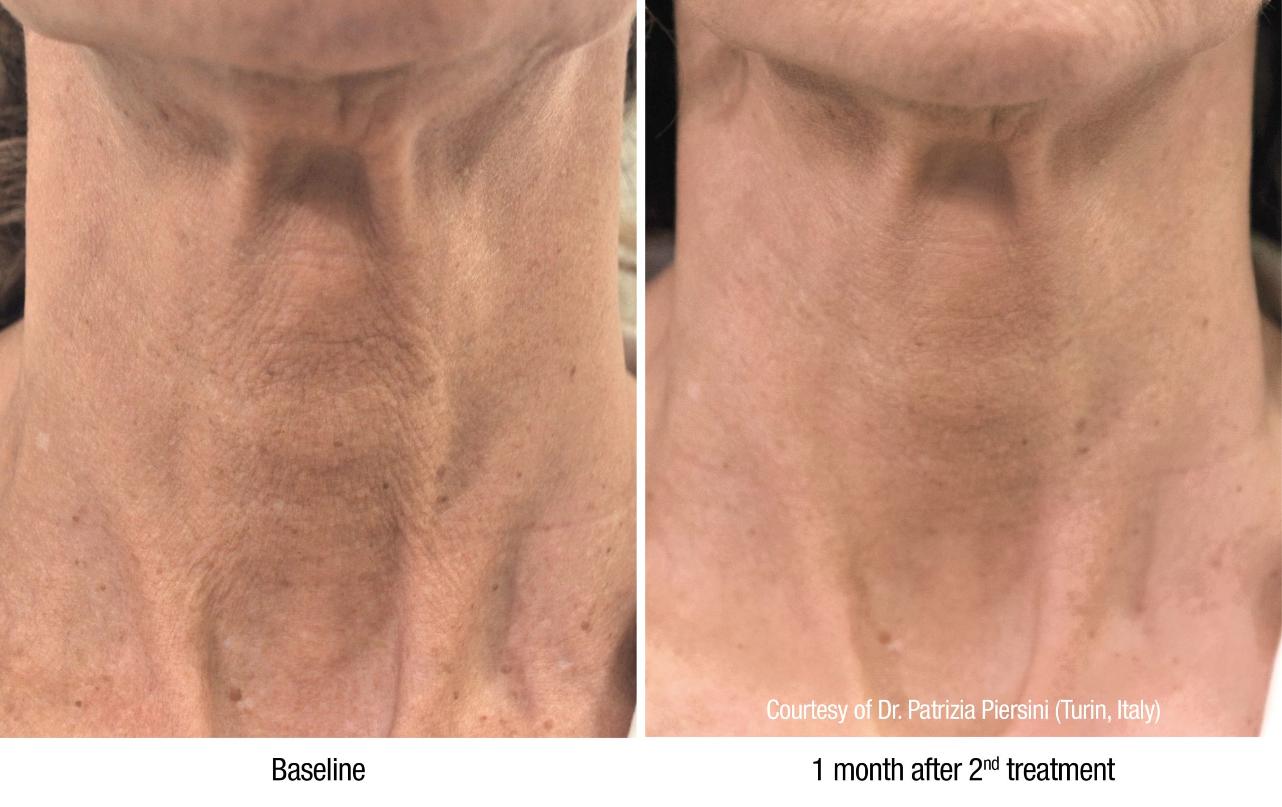 Profhilo before and after