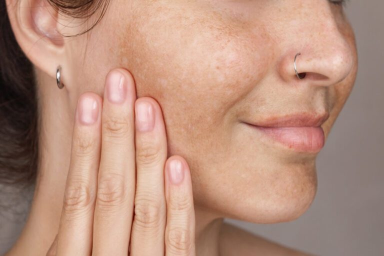Laser for Hyperpigmentation