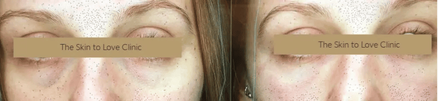 Sunekos Treatment Results at The Skin To Love Clinic