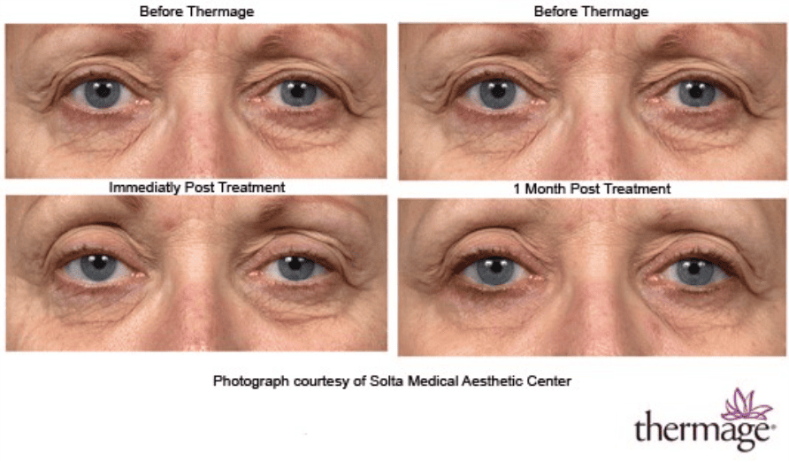Thermage Treatment