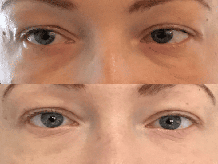 "Close-up before and after photos of a patient's under-eye area, showing reduced under-eye hollowing and smoother skin